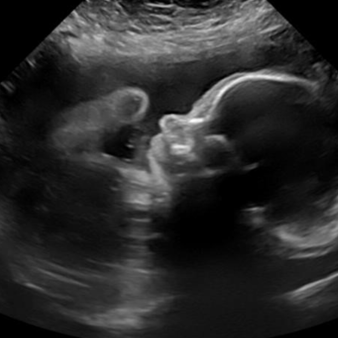 Baby Ultrasound Scan